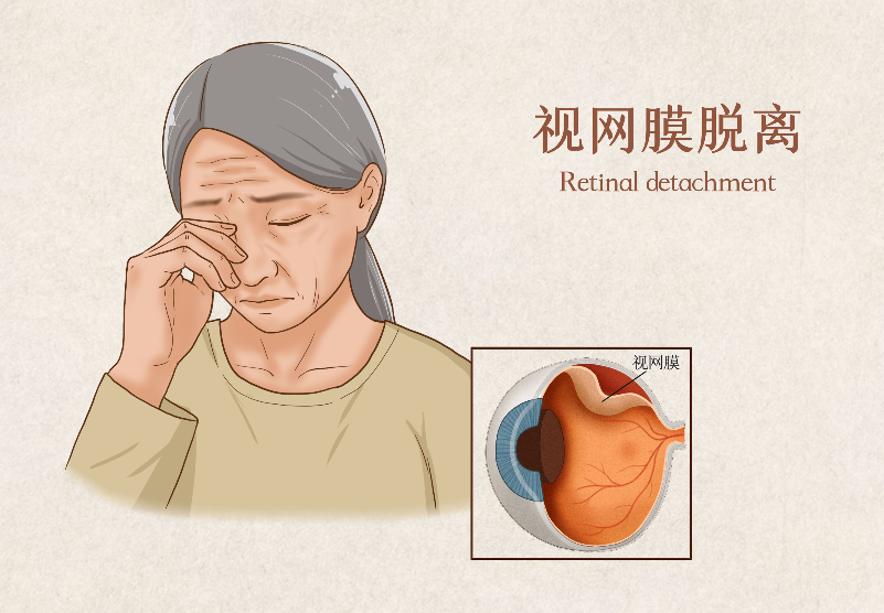 視網(wǎng)膜脫落手術(shù)費用