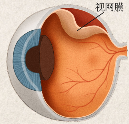 視網(wǎng)膜脫離