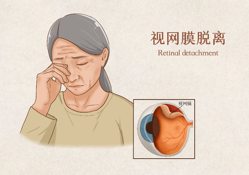 視網(wǎng)膜脫離手術(shù)多長(cháng)時(shí)間