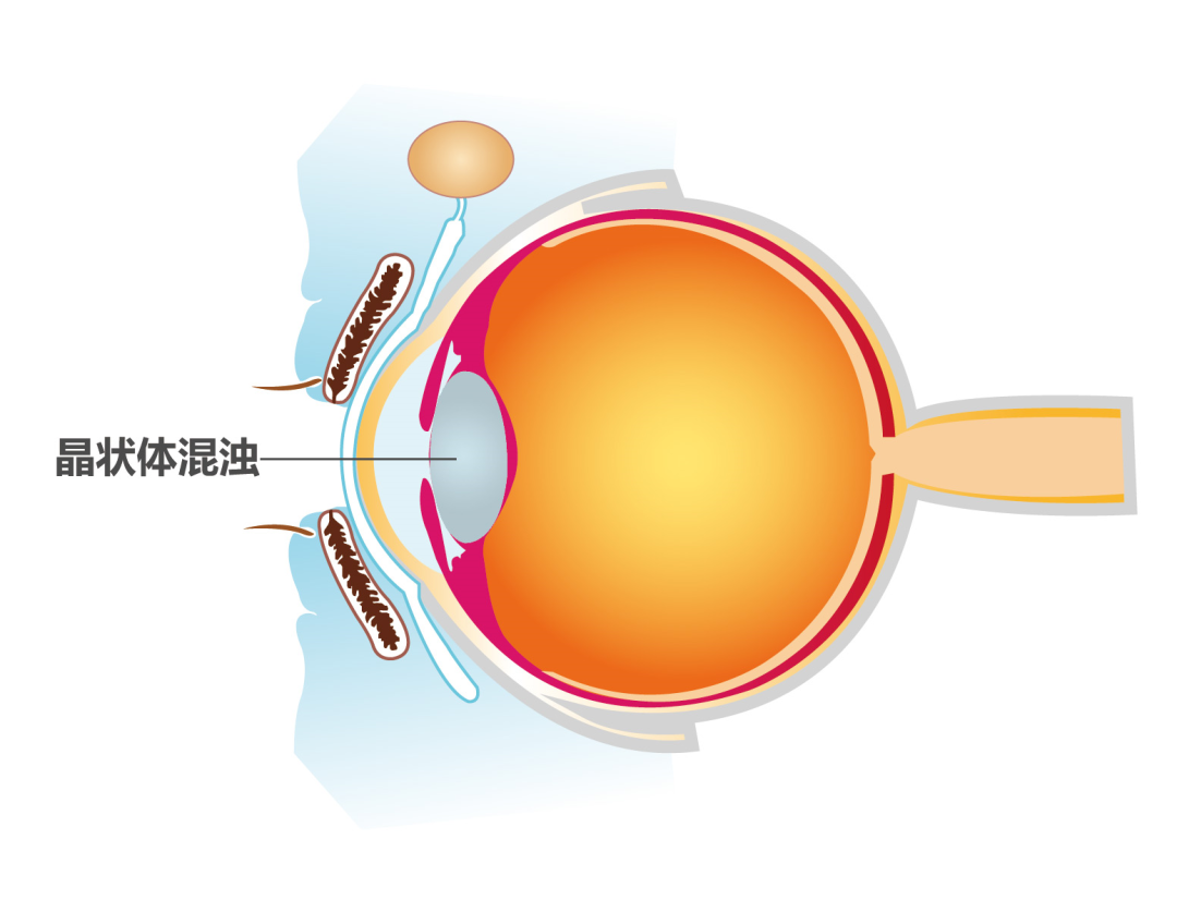 白內障癥狀