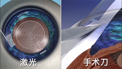 老花眼手術(shù)